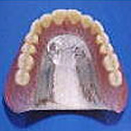 純チタン鋳造床義歯